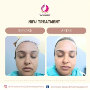 drneha-dermatologist-clients-treatment-photos (1)