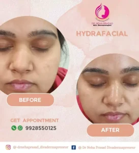 drneha-dermatologist-clients-treatment-photos (2)