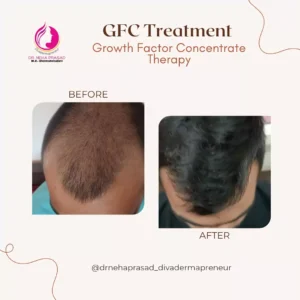 drneha-dermatologist-clients-treatment-photos (3)